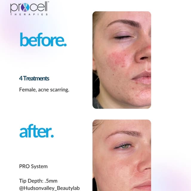 Procell Microchanneling at Blessed Beauty Aesthetics, LLC in Houston, TX