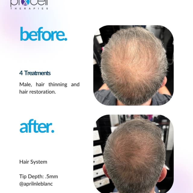 Microchanneling Hair Restoration at Blessed Beauty Aesthetics, LLC in Houston, TX
